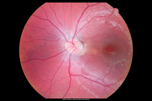 Optic Nerve Pit  Retinal Detachment - Macular Detachment - 8 Year Old - 5/200 Vision OS
8-year-old child on two school exams that his vision was poor in the left eye and his last normal exam was in preschool. 

VISUAL ACUITY:  OD 20/30,  OS 5/200.   OS: Vertical C/D ratio is 0.2.  There is a whitening on the temporal edge of the optic nerve consistent with an optic disc pit and there is a serous macular detachment.  

