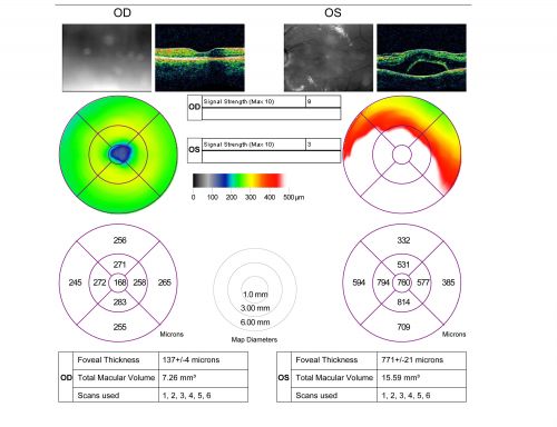 Optic Nerve Pit  Retinal Detachment - Macular Detachment - 8 Year Old - 5/200 Vision OS
8-year-old child on two school exams that his vision was poor in the left eye and his last normal exam was in preschool. 

VISUAL ACUITY:  OD 20/30,  OS 5/200.   OS: Vertical C/D ratio is 0.2.  There is a whitening on the temporal edge of the optic nerve consistent with an optic disc pit and there is a serous macular detachment.  

