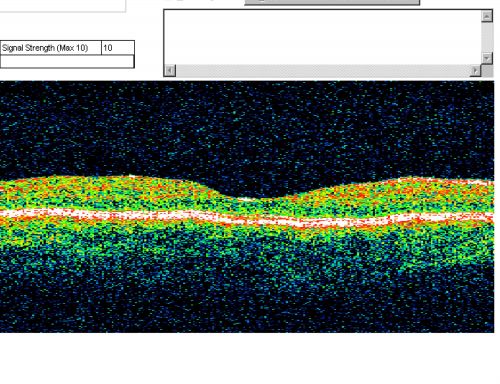 Optic Nerve Pit  Retinal Detachment - Macular Detachment - 8 Year Old - 5/200 Vision OS
8-year-old child on two school exams that his vision was poor in the left eye and his last normal exam was in preschool. 

VISUAL ACUITY:  OD 20/30,  OS 5/200.   OS: Vertical C/D ratio is 0.2.  There is a whitening on the temporal edge of the optic nerve consistent with an optic disc pit and there is a serous macular detachment.  

