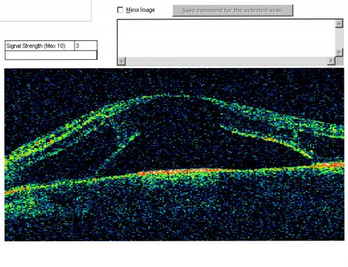 Optic Nerve Pit  Retinal Detachment - Macular Detachment - 8 Year Old - 5/200 Vision OS
8-year-old child on two school exams that his vision was poor in the left eye and his last normal exam was in preschool. 

VISUAL ACUITY:  OD 20/30,  OS 5/200.   OS: Vertical C/D ratio is 0.2.  There is a whitening on the temporal edge of the optic nerve consistent with an optic disc pit and there is a serous macular detachment.  

