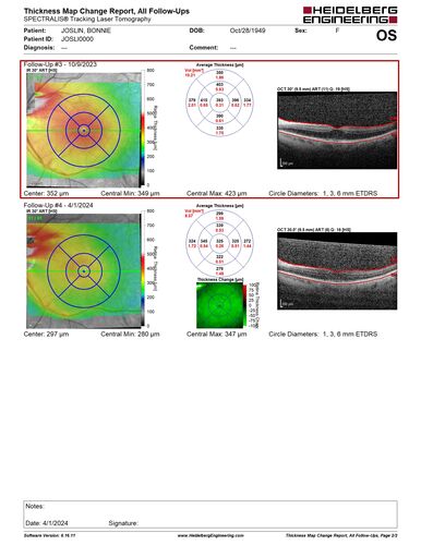 Macular schisis with no leakage on FA - Presumed Nerve pit maculopathy - NO THERAPY - BETTER
73-year old female.  Had treatment trial with Eylea with no benefit (4 months).  Vision is 20/32 in left eye and has remained there (with a dense cataract).
