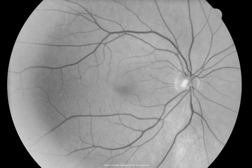 Atypical Neuroretinitis - ?Ischemic - ?Paraneoplastic - Normal Right Eye
74-year-old woman has stage 4 non-small cell lung carcinoma decreasing vision in the left eye for at least the last two weeks, VA 10/200. Trace APD OS.  No pain
Keywords: swollen nerve;aion;neuroretinitis;paraneoplastic