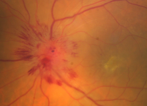 Atypical Neuroretinitis - ?Ischemic - ?Paraneoplastic - Optic Nerve Swelling and Foveal Edema and Exudate
74-year-old woman has stage 4 non-small cell lung carcinoma decreasing vision in the left eye for at least the last two weeks, VA 10/200. Trace APD OS.  No pain
Keywords: swollen nerve;aion;neuroretinitis;paraneoplastic