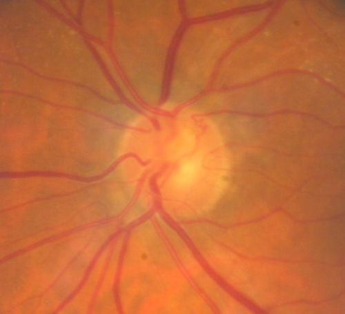 Atypical Neuroretinitis - ?Ischemic - ?Paraneoplastic - Telangiectatic Vessels on Nerve After Edema Subsided
No treatment was done and the nerve swelling subsided over about 6 months.  This photo is taken one year after the ones showing swelling.  There is still a trace APD.
Keywords: swollen nerve;aion;neuroretinitis;paraneoplastic
