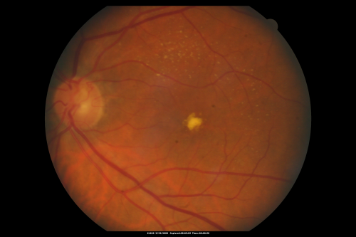 Atypical Neuroretinitis - ?Ischemic - ?Paraneoplastic - Macular Exudate Left Eye
No treatment was done and the nerve swelling subsided over about 6 months.  This photo is taken one year after the ones showing swelling.  There is still a trace APD.
Võtmesõnad: swollen nerve;aion;neuroretinitis;paraneoplastic