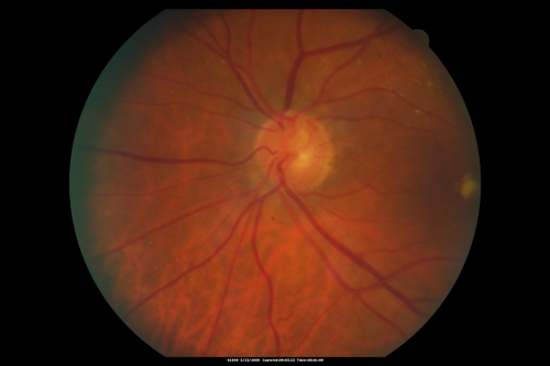 Atypical Neuroretinitis - ?Ischemic - ?Paraneoplastic Fundus Photo 1 year after initial episode VA 20/200
No treatment was done and the nerve swelling subsided over about 6 months.  This photo is taken one year after the ones showing swelling.  There is still a trace APD.
Keywords: swollen nerve;aion;neuroretinitis;paraneoplastic
