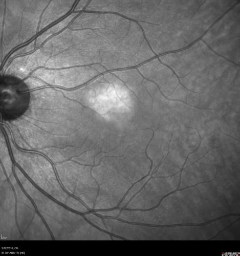 Choroidal Nevus - Macula - Flat
37 year old female with 5 year stable nevus Left eye - OCT shows flat nevus (EDI scan)
