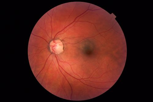 Choroidal Nevus - Macula - Flat
37 year old female with 5 year stable nevus Left eye - OCT shows flat nevus (EDI scan)
