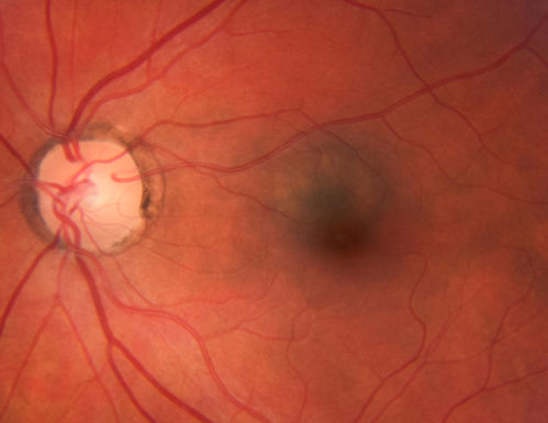 Choroidal Nevus - Macula - Flat
37 year old female with 5 year stable nevus Left eye - OCT shows flat nevus (EDI scan)
