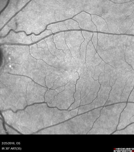Amelanotic Choroidal Nevus - Multimodal Imaging
61 year old man with amelanotic choroidal nevus.  Vision Normal - Stable over 4 years.
