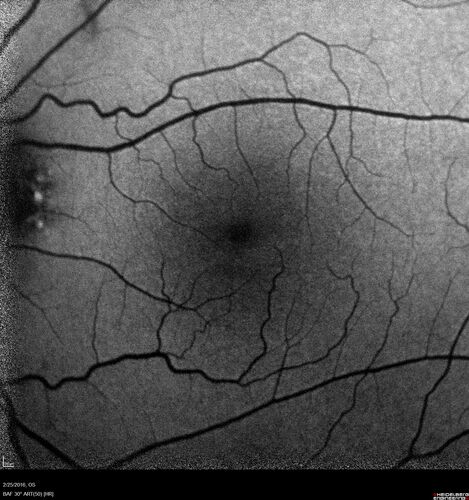 Amelanotic Choroidal Nevus - Multimodal Imaging
61 year old man with amelanotic choroidal nevus.  Vision Normal - Stable over 4 years.
