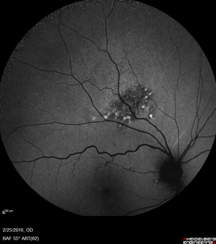 Amelanotic Choroidal Nevus - Multimodal Imaging
61 year old man with amelanotic choroidal nevus.  Vision Normal - Stable over 4 years.
