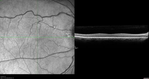 Amelanotic Choroidal Nevus - Multimodal Imaging
61 year old man with amelanotic choroidal nevus.  Vision Normal - Stable over 4 years.
