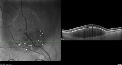 Amelanotic Choroidal Nevus - Multimodal Imaging
61 year old man with amelanotic choroidal nevus.  Vision Normal - Stable over 4 years.
