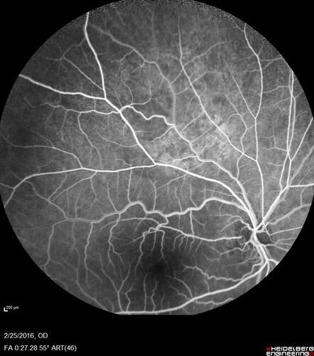Amelanotic Choroidal Nevus - Multimodal Imaging
61 year old man with amelanotic choroidal nevus.  Vision Normal - Stable over 4 years.
