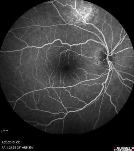 Amelanotic Choroidal Nevus - Multimodal Imaging
61 year old man with amelanotic choroidal nevus.  Vision Normal - Stable over 4 years.
