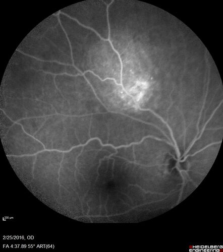 Amelanotic Choroidal Nevus - Multimodal Imaging
61 year old man with amelanotic choroidal nevus.  Vision Normal - Stable over 4 years.
