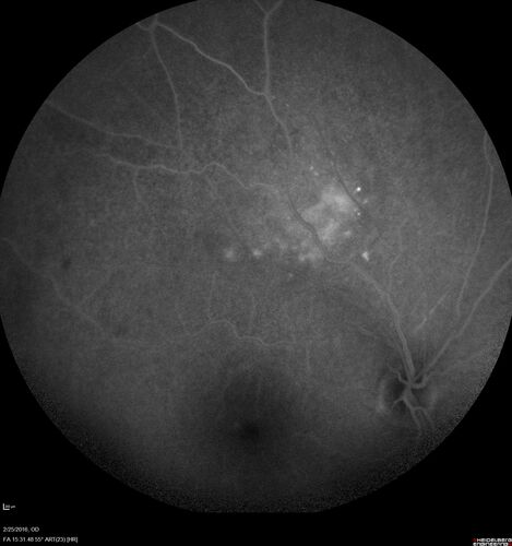 Amelanotic Choroidal Nevus - Multimodal Imaging
61 year old man with amelanotic choroidal nevus.  Vision Normal - Stable over 4 years.
