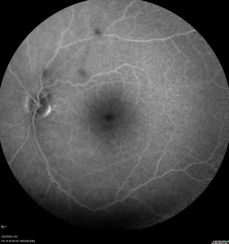 Amelanotic Choroidal Nevus - Multimodal Imaging
61 year old man with amelanotic choroidal nevus.  Vision Normal - Stable over 4 years.
