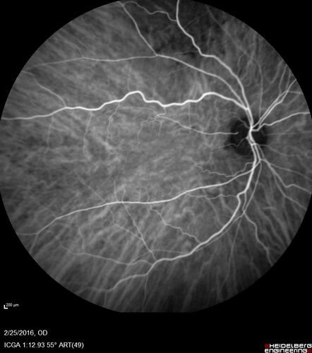 Amelanotic Choroidal Nevus - Multimodal Imaging
61 year old man with amelanotic choroidal nevus.  Vision Normal - Stable over 4 years.
