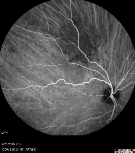 Amelanotic Choroidal Nevus - Multimodal Imaging
61 year old man with amelanotic choroidal nevus.  Vision Normal - Stable over 4 years.
