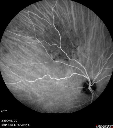Amelanotic Choroidal Nevus - Multimodal Imaging
61 year old man with amelanotic choroidal nevus.  Vision Normal - Stable over 4 years.
