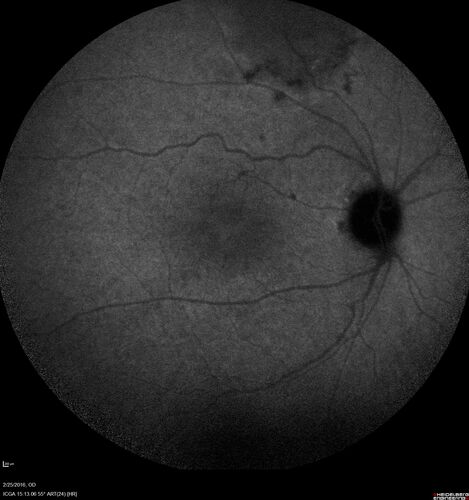 Amelanotic Choroidal Nevus - Multimodal Imaging
61 year old man with amelanotic choroidal nevus.  Vision Normal - Stable over 4 years.
