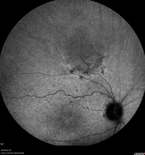 Amelanotic Choroidal Nevus - Multimodal Imaging
61 year old man with amelanotic choroidal nevus.  Vision Normal - Stable over 4 years.
