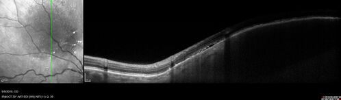 Amelanotic Choroidal Nevus - Multimodal Imaging
61 year old man with amelanotic choroidal nevus.  Vision Normal - Stable over 4 years.
