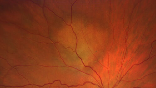 Amelanotic Choroidal Nevus
60 year old man.  Nevus is stable over 6 years.  Images are Photo, FAF, OCT, FA, ICG, and B-Scan
