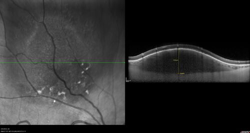 Amelanotic Choroidal Nevus
60 year old man.  Nevus is stable over 6 years.  Images are Photo, FAF, OCT, FA, ICG, and B-Scan
