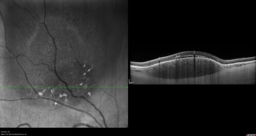 Amelanotic Choroidal Nevus
60 year old man.  Nevus is stable over 6 years.  Images are Photo, FAF, OCT, FA, ICG, and B-Scan
