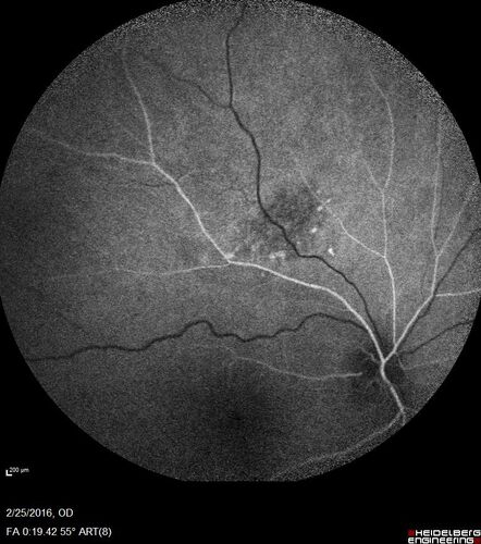 Amelanotic Choroidal Nevus
60 year old man.  Nevus is stable over 6 years.  Images are Photo, FAF, OCT, FA, ICG, and B-Scan
