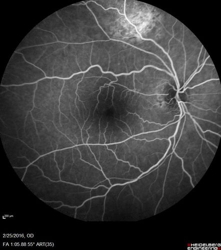 Amelanotic Choroidal Nevus
60 year old man.  Nevus is stable over 6 years.  Images are Photo, FAF, OCT, FA, ICG, and B-Scan

