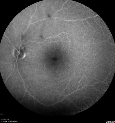Amelanotic Choroidal Nevus
60 year old man.  Nevus is stable over 6 years.  Images are Photo, FAF, OCT, FA, ICG, and B-Scan
