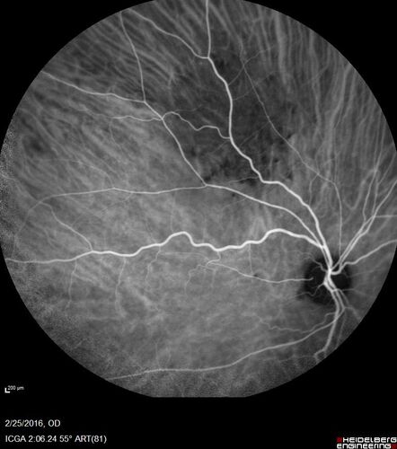 Amelanotic Choroidal Nevus
60 year old man.  Nevus is stable over 6 years.  Images are Photo, FAF, OCT, FA, ICG, and B-Scan
