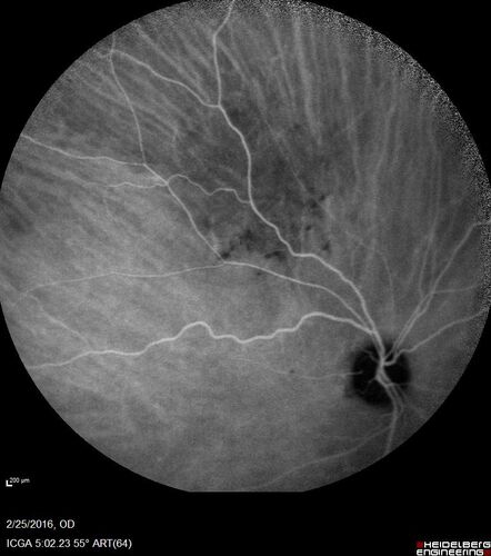 Amelanotic Choroidal Nevus
60 year old man.  Nevus is stable over 6 years.  Images are Photo, FAF, OCT, FA, ICG, and B-Scan
