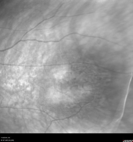 Choroidal Nevus with Drusen
82 year old female with flat nevus for 3 years.
