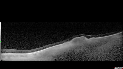 Choroidal Nevus with Drusen
82 year old female with flat nevus for 3 years.
