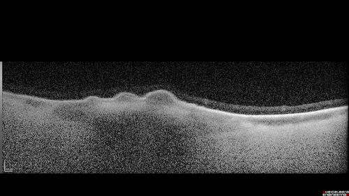 Choroidal Nevus with Drusen
82 year old female with flat nevus for 3 years.
