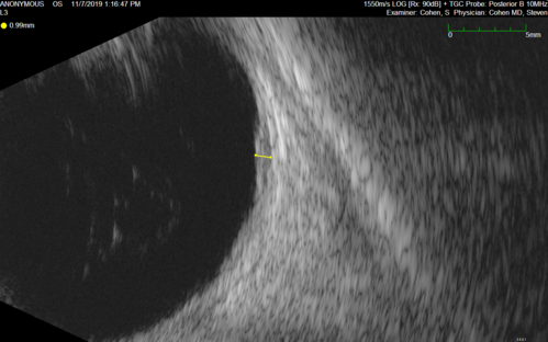Choroidal Nevus with Drusen
82 year old female with flat nevus for 3 years.
