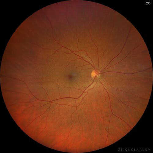 Choroidal nevus
Stable for 8 years.
