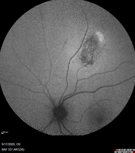 Choroidal nevus
Stable for 8 years.
