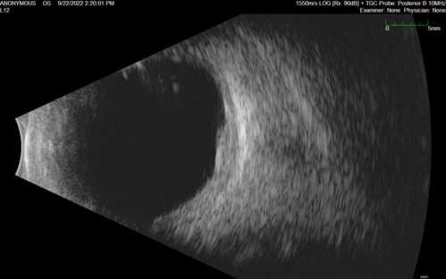 Choroidal nevus
Stable for 8 years.
