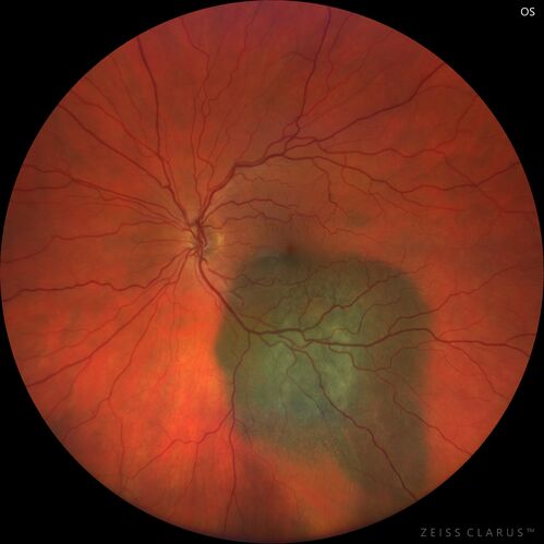 Large chronic choroidal nevus
Autofluorescence image shows guttering at the bottom of the lesion suggesting chronicity.  This was documented 23 years prior to these photos
