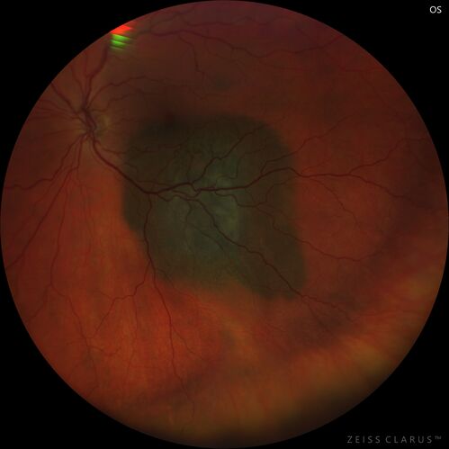 Large chronic choroidal nevus
Autofluorescence image shows guttering at the bottom of the lesion suggesting chronicity.  This was documented 23 years prior to these photos
