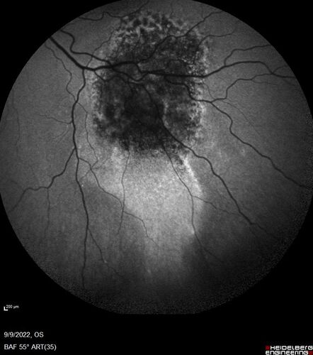 Large chronic choroidal nevus
Autofluorescence image shows guttering at the bottom of the lesion suggesting chronicity.  This was documented 23 years prior to these photos
