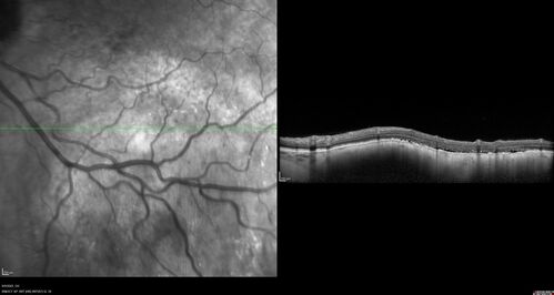 Large chronic choroidal nevus
Autofluorescence image shows guttering at the bottom of the lesion suggesting chronicity.  This was documented 23 years prior to these photos
