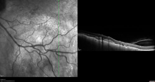 Large chronic choroidal nevus
Autofluorescence image shows guttering at the bottom of the lesion suggesting chronicity.  This was documented 23 years prior to these photos
