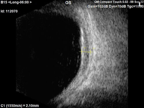 Large chronic choroidal nevus
Autofluorescence image shows guttering at the bottom of the lesion suggesting chronicity.  This was documented 23 years prior to these photos
